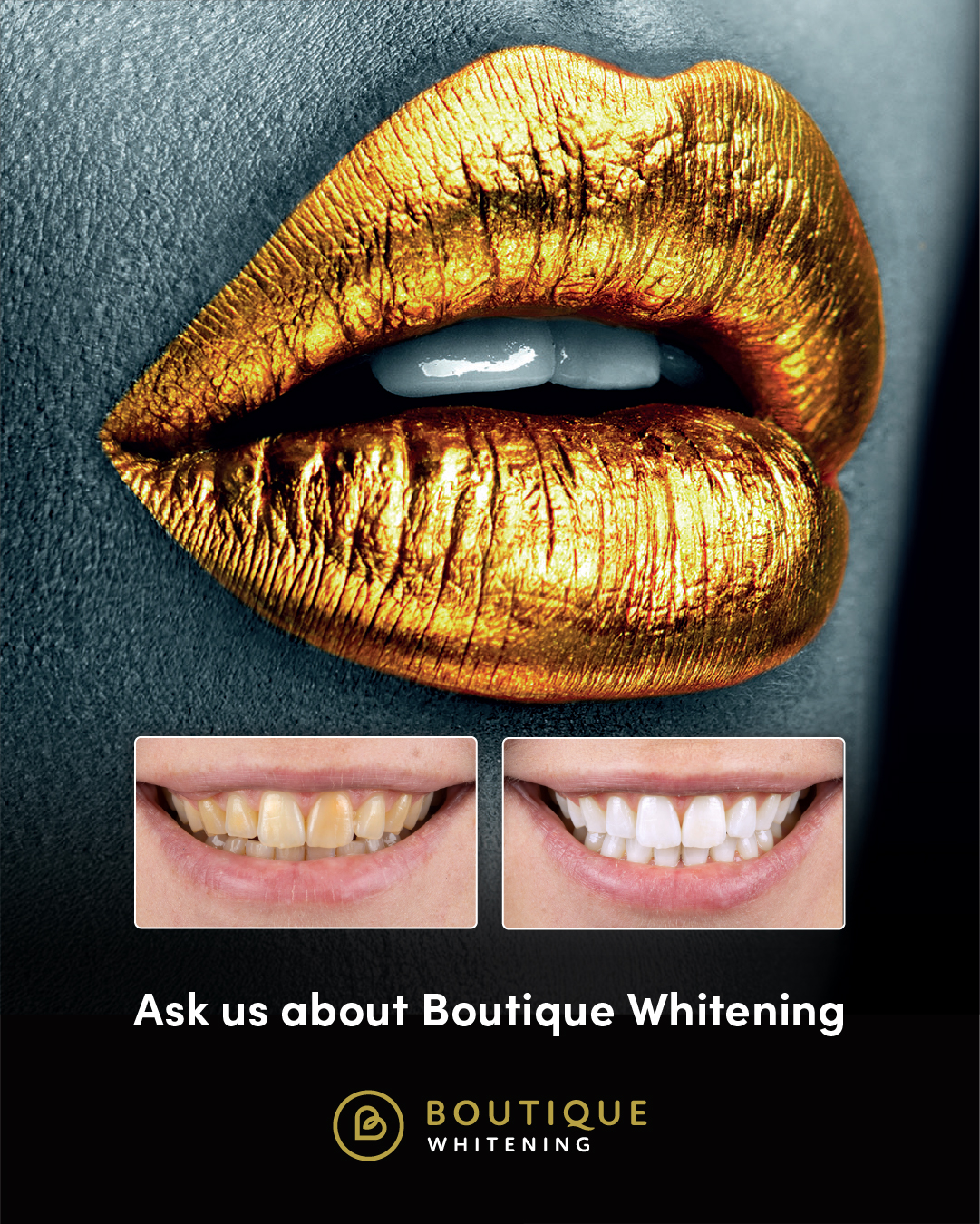 Boutique Whitening — professional teeth whitening at Pont Steffan Dental